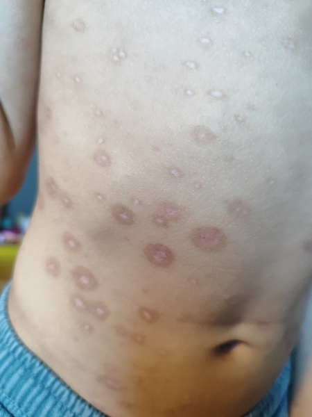 Are these chicken pox spots infected?