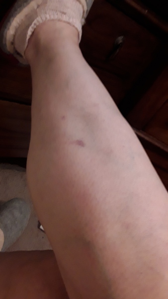 Any nurses here? I have body lice