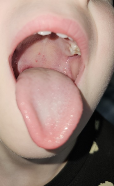 What is this in DS's throat?
