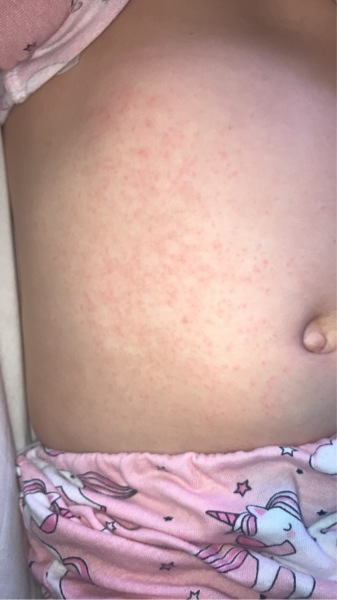 What is this rash 