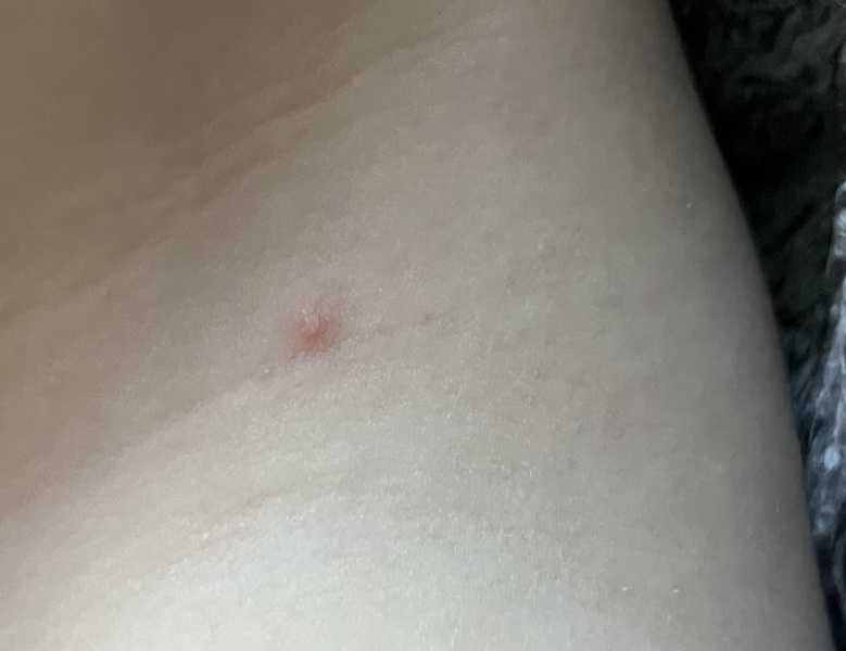 Is this Chickenpox? 