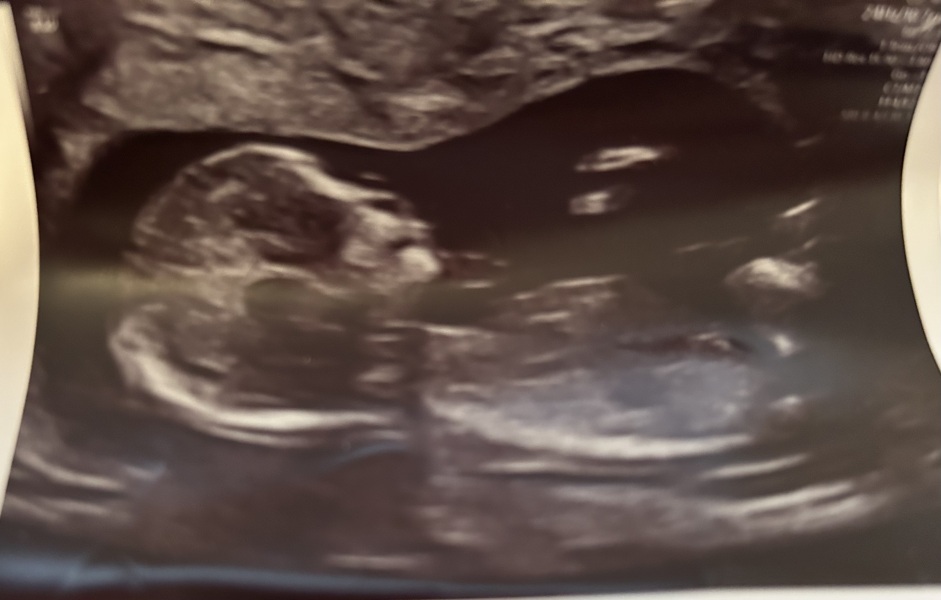 First cycle - IVF / ICSI - Day 4 