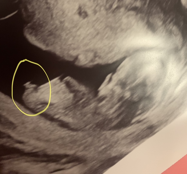 Nub or leg? Boy or girl?
