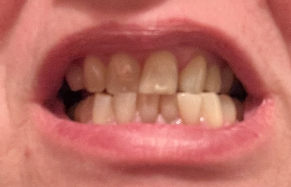 Teeth whitening and straightening potentially