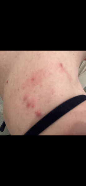 Is this shingles? 