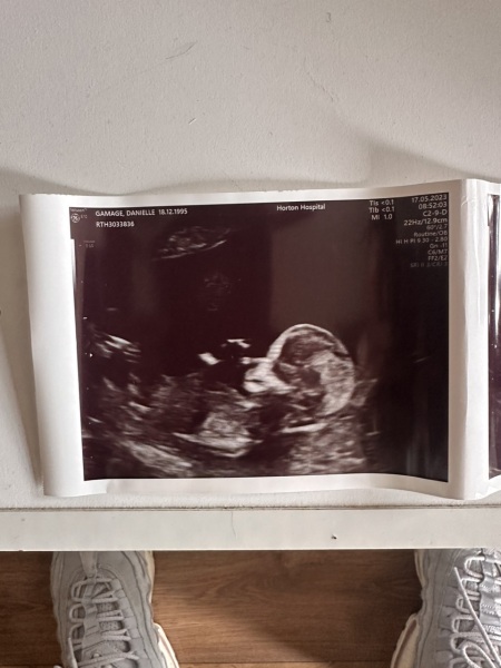 Nub theory - guess my baby's gender!