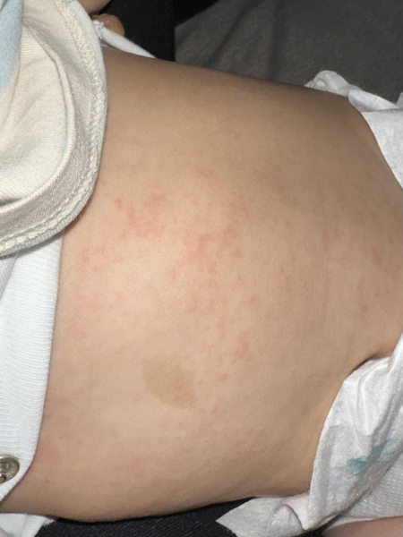 7 month old has a rash on his tummy and back