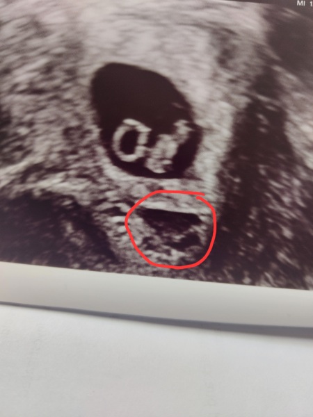 Help to understand ultrasound please