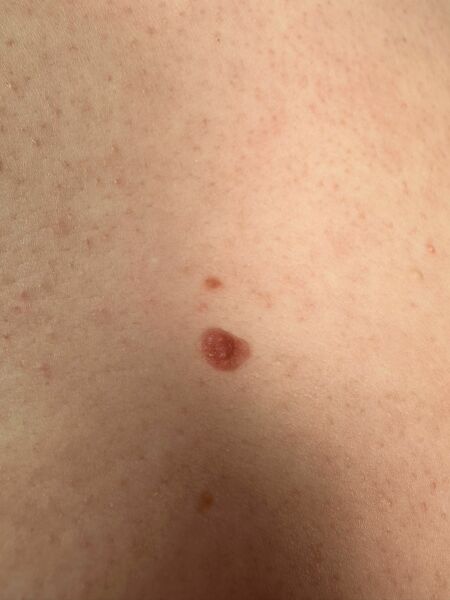 Worried about mole 