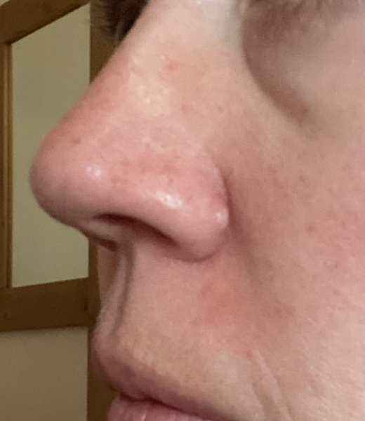 What is this?  Please help identify this isolated long lasting spot? 