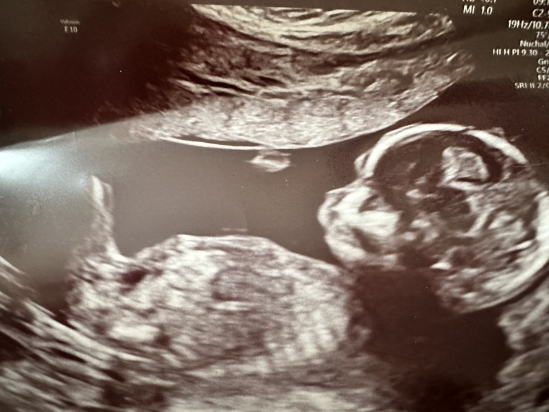 Nub/Skull Theory! Girl or Boy? 