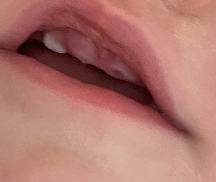 Teething - Strange Black Mark? 