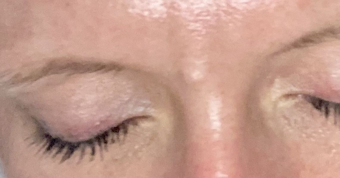 Raised beauty spot removal? Pic attached