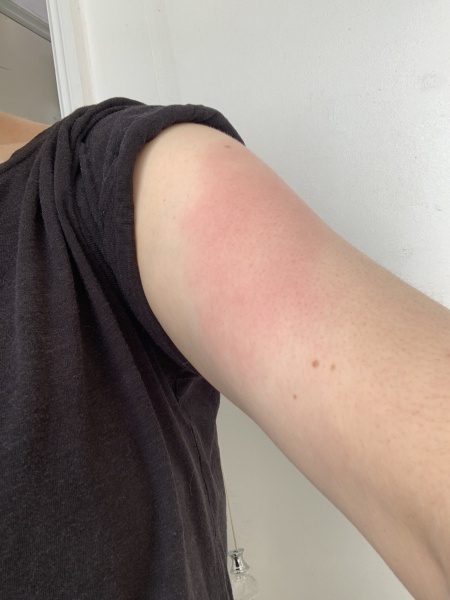 Red, painful arm after vaccination
