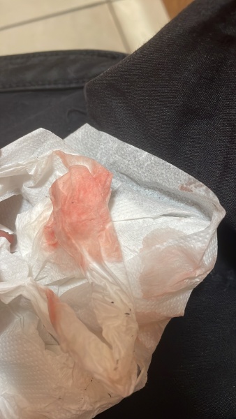 Light bleeding photos attached 
