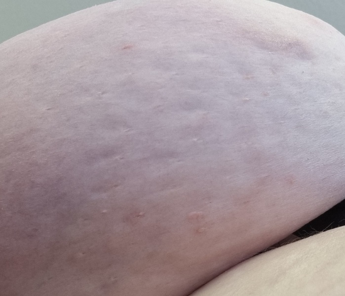 Is this dimpling? 