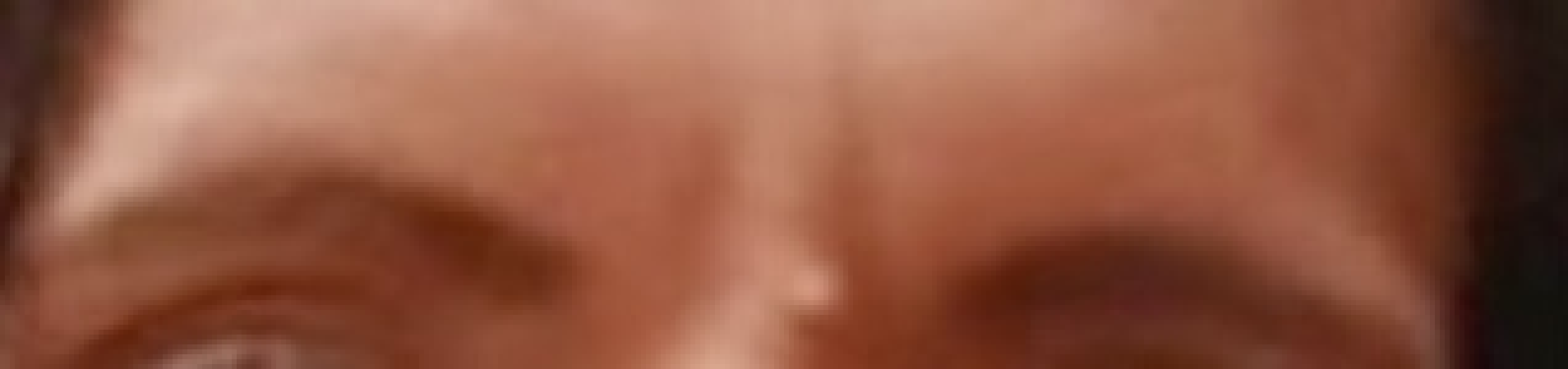Raised beauty spot removal? Pic attached