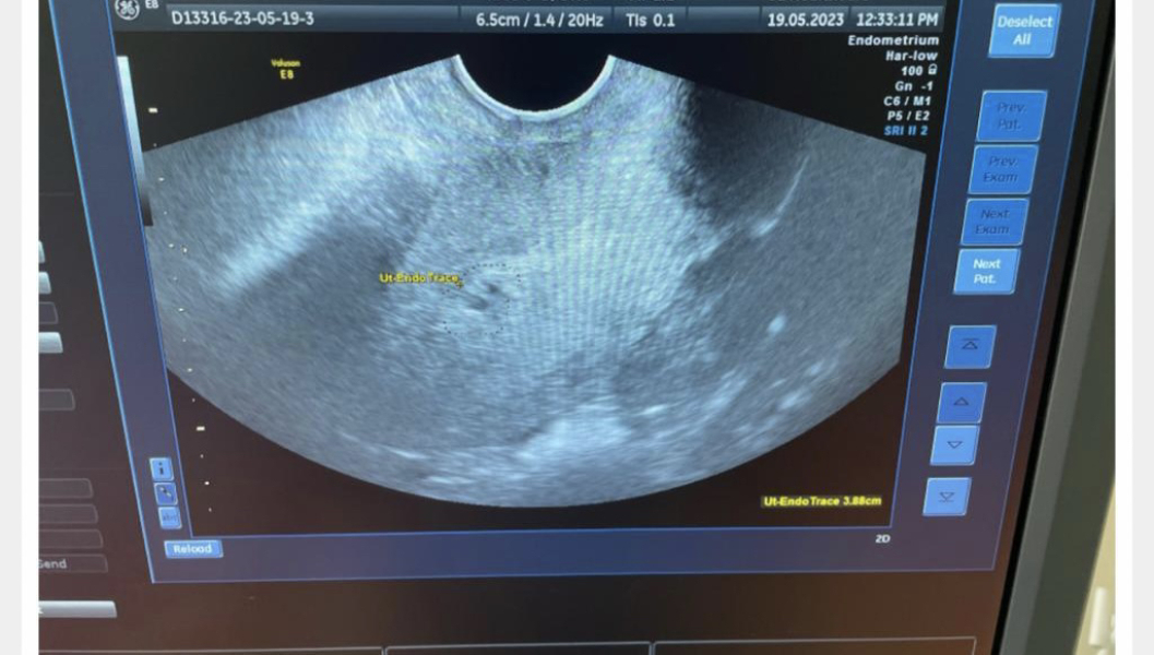 ERA/Alice/Emma infertility thread graduates/pregnancies