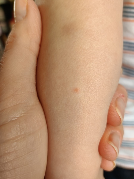 Chicken pox?