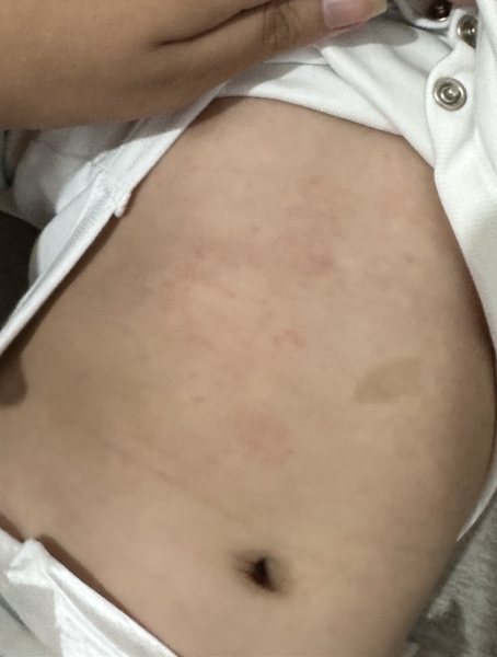 7 month old has a rash on his tummy and back