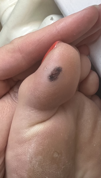 Verrucas - advice needed
