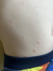 Does this look like chickenpox? 