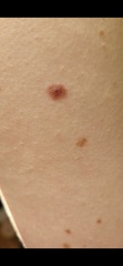 Dodgy mole