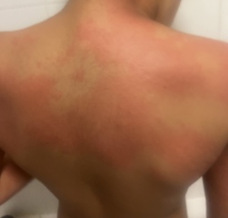 Can some one help me around this rash 