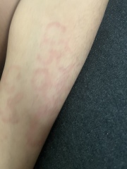 Can some one help me around this rash 