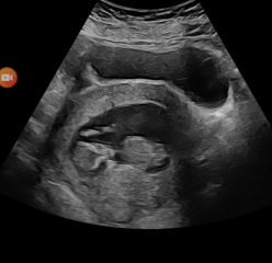 12 weeks 1 day!! Can anyone see the nub???