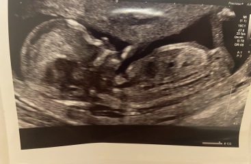 11 week scan - nub theory 