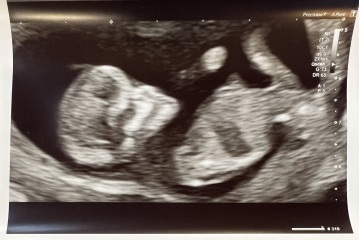 Boy or Girl?