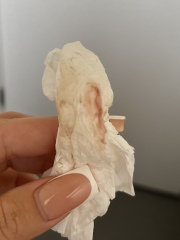 Potential miscarriage with bleeding 6 weeks
