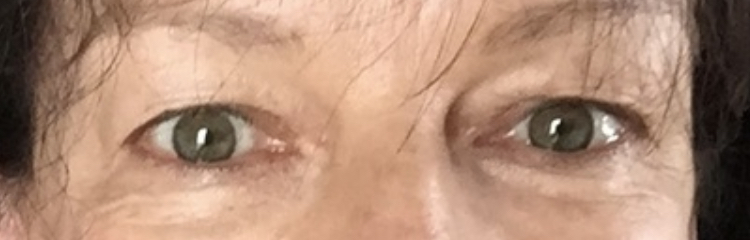 Mr Naresh Joshi - Blepharoplasty