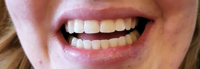 Teeth whitening and straightening potentially