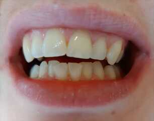 Teeth whitening and straightening potentially