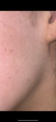 Awful facial excess hair pregnancy symptoms:(
