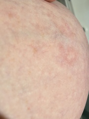 White patch on boob