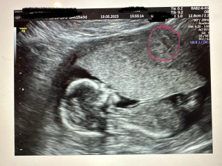 ERA/Alice/Emma infertility thread graduates/pregnancies