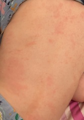 Scarlet fever rash??