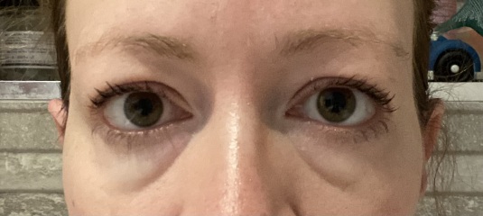 Is there a magic cream to tighten eye bags?!