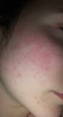 Rosacea flare up after years of good skin 