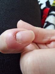 I am going to lose my nail?