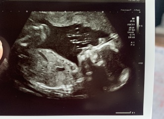 22 weeks boy or girl?