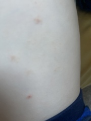 Does this look like chickenpox? 