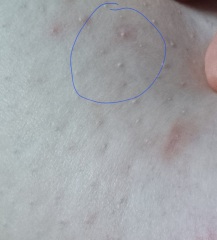 Is this dimpling? 