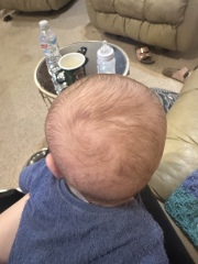 Lump on my 3 month baby’s head