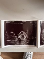 Nub theory - guess my baby's gender!