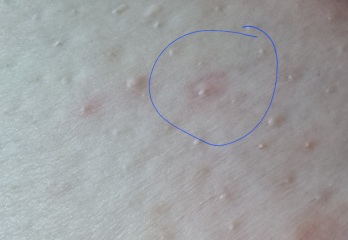 Is this dimpling? 