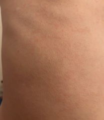 Scarlet fever rash??